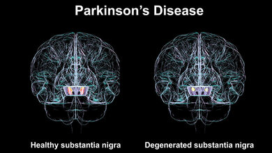 Bilder des Gehirns, die die Veränderungen bei Parkinson aufzeigen.