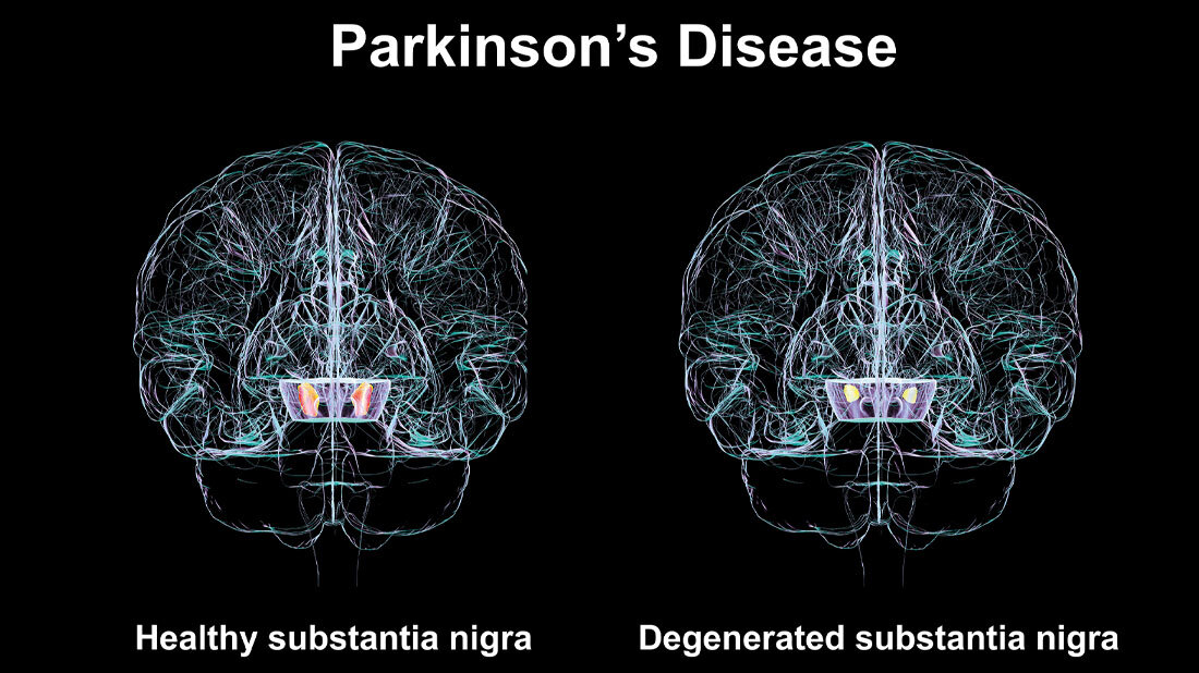 Bilder des Gehirns, die die Veränderungen bei Parkinson aufzeigen.
