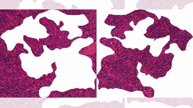 Schnitt durch Brustkrebsgewebe