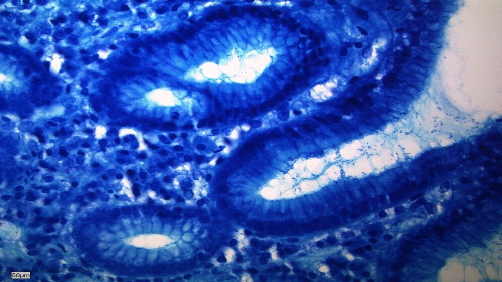 Helicobacter-pylori-Infektion