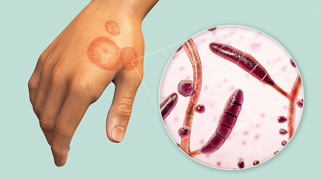 Grafik einer infizierten Hand mit Vergrößerung der Dermatophyten