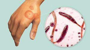Grafik einer infizierten Hand mit Vergrößerung der Dermatophyten