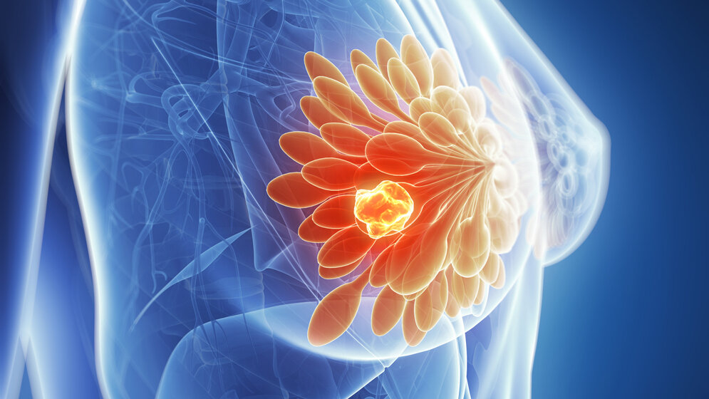 Brustkrebs