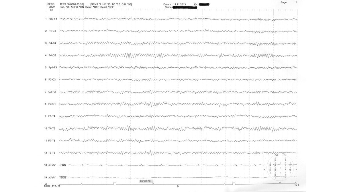Das normale Elektroenzephalogramm (EEG) Neurologische Funktionsdiagnostik