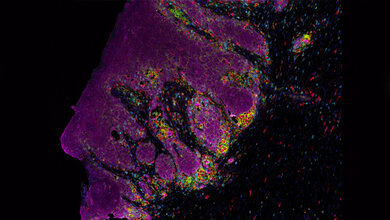 Mehrfarbige Immunfluoreszenz von Tumor und Immunzellen 