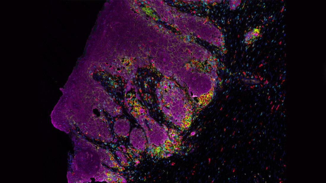 Mehrfarbige Immunfluoreszenz von Tumor und Immunzellen 
