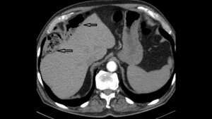 Anomalien und Normvarianten: Interne Veränderungen 2.6: Chilaiditi