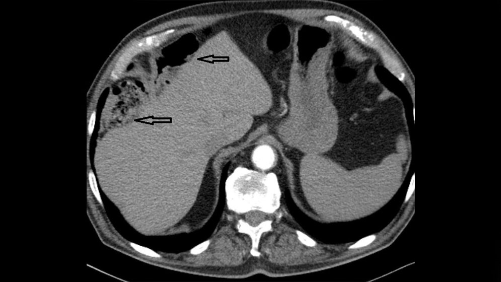 Anomalien und Normvarianten: Interne Veränderungen 2.6: Chilaiditi