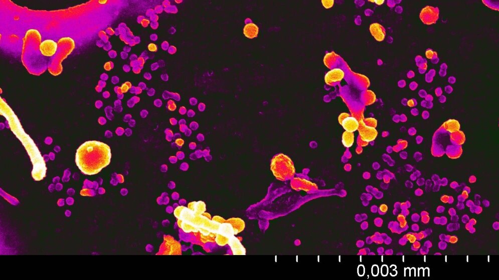 Freisetzung von HIV-Partikel von infizierten menschlichen Zellen