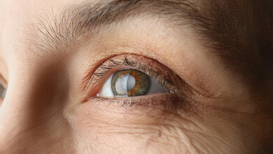 Title picture of the english expert article on cataracts