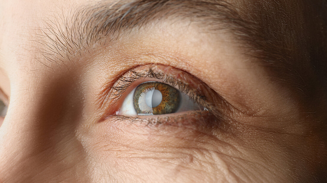 Title picture of the english expert article on cataracts