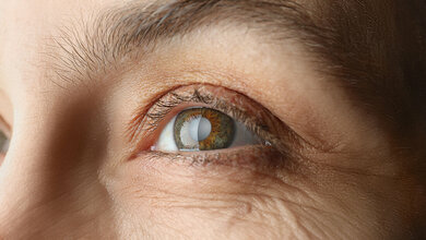 Title picture of the english expert article on cataracts