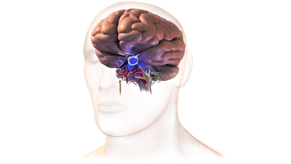 Hypophysentumor_BruceBlaus_Eigenes_Werk_CC_BY_SA_4_0_wikimedia.jpg Hypophysentumor