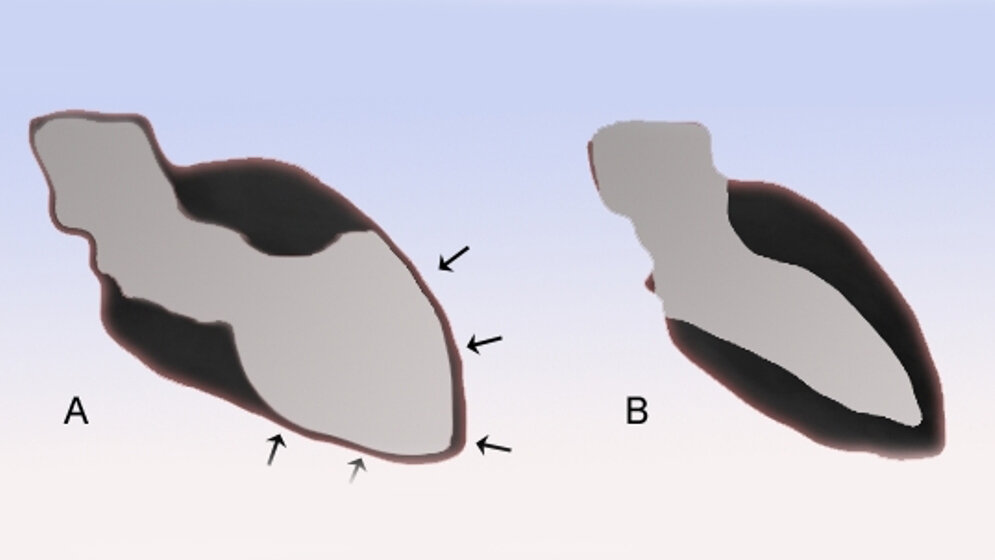 Tako-Tsubo Kardiomyopathie (A) und Normalperson (B)