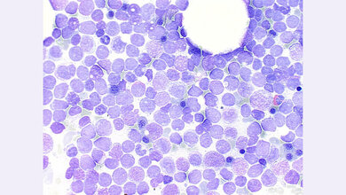 Bei der AML gerät das blutbildende System außer Kontrolle