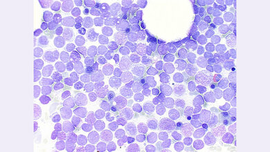 Bei der AML gerät das blutbildende System außer Kontrolle