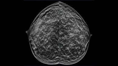 Mammografie einer 40-jährigen Patientin.