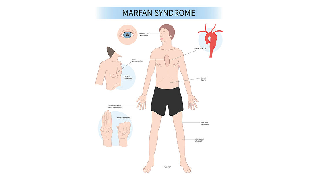 Das Marfan-Syndrom Grafik zum Erscheinungsbild des Marfan-Syndroms