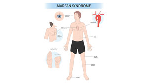 Grafik zum Erscheinungsbild des Marfan-Syndroms