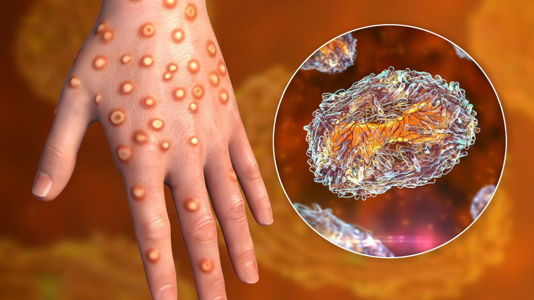 Neues Medikament gegen Affenpocken?