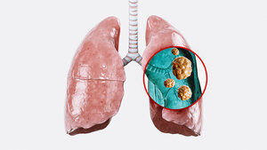 Grafik der menschlichen Lungenflügel mit vergrößerter Darstellung von Tumoren