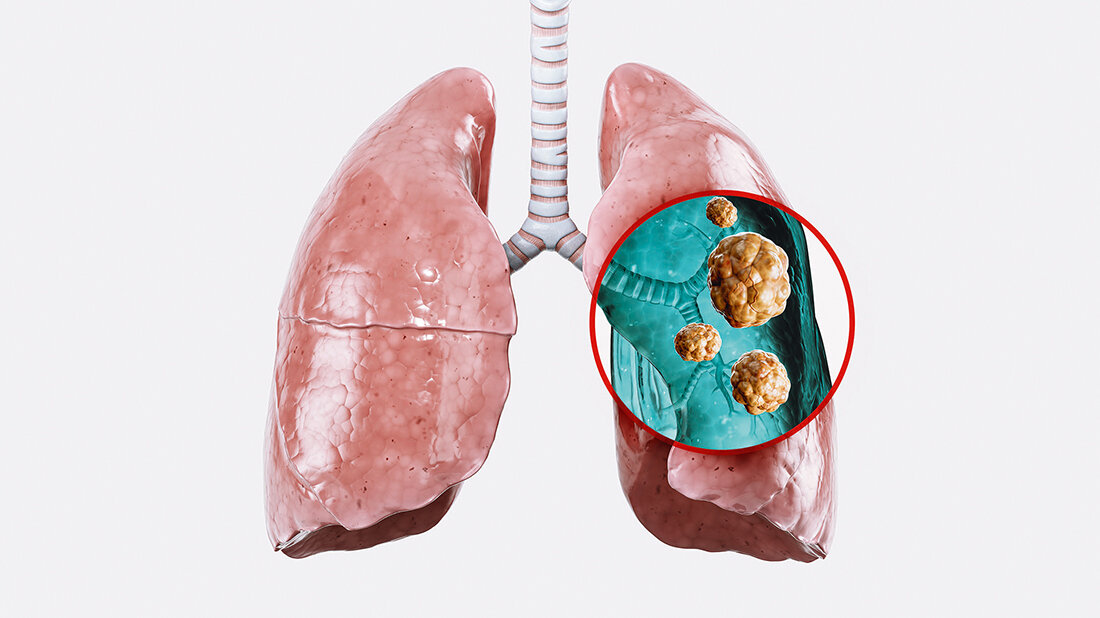 Grafik der menschlichen Lungenflügel mit vergrößerter Darstellung von Tumoren
