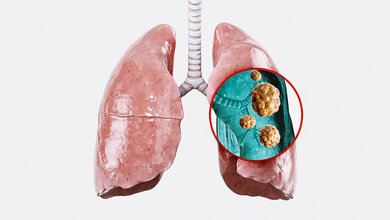 Grafik der menschlichen Lungenflügel mit vergrößerter Darstellung von Tumoren