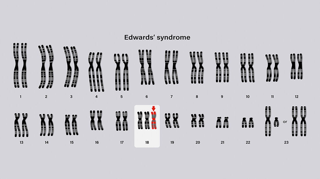 Das Edwards-Syndrom (Trisomie 18) Darstellung der Trisomie am Gen 18 beim Edwards-Syndrom