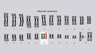 Darstellung der Trisomie am Gen 18 beim Edwards-Syndrom
