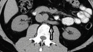 Posteriores Nussknacker-Syndrom