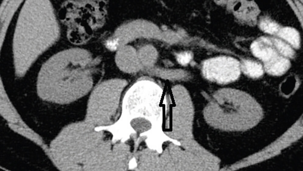 Posteriores Nussknacker-Syndrom