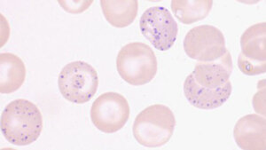 Basophile Tüpfelung der Erythrozyten