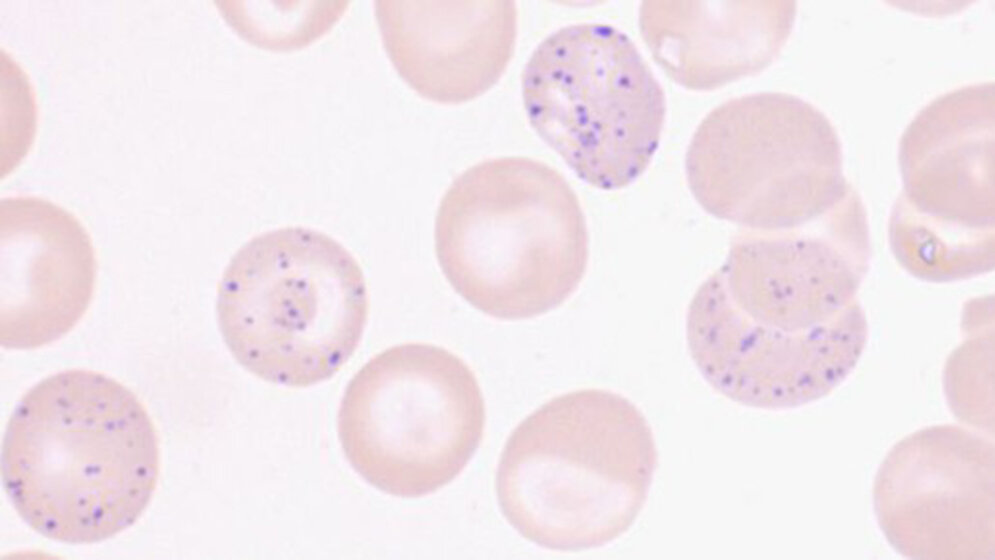 Basophile Tüpfelung der Erythrozyten