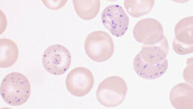 Basophile Tüpfelung der Erythrozyten