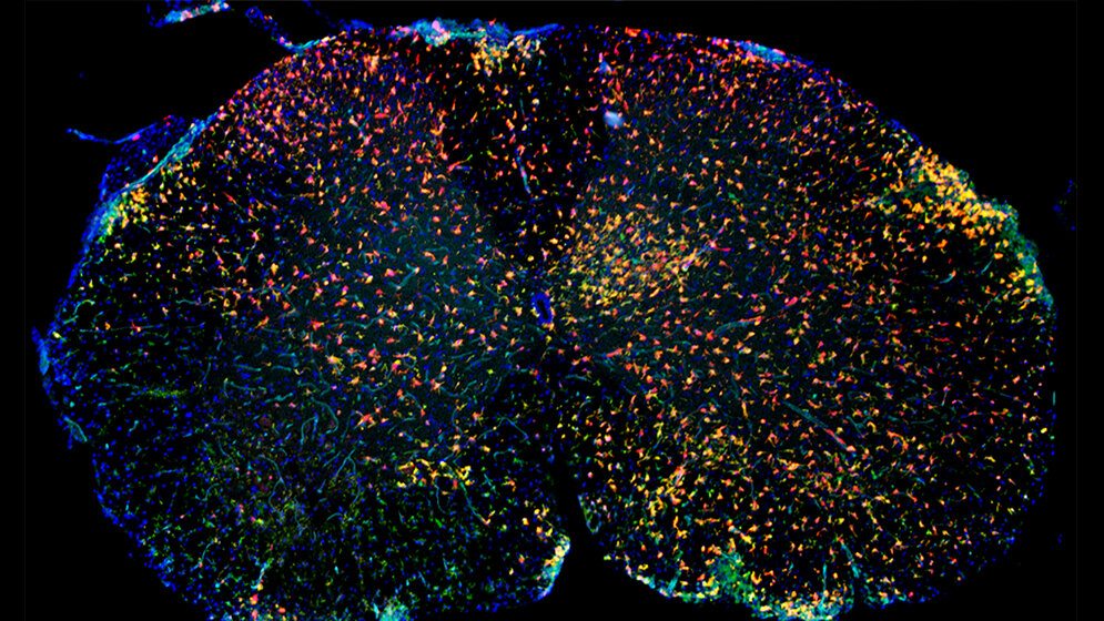Immunfluoreszenz von entzündlich verändertem Rückenmark 