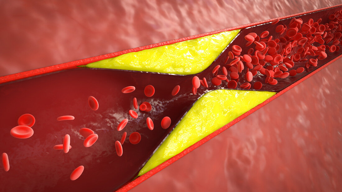 Atherosklerose_Therapieansatz.jpg Neue Atherosklerose-Therapie in Sicht?