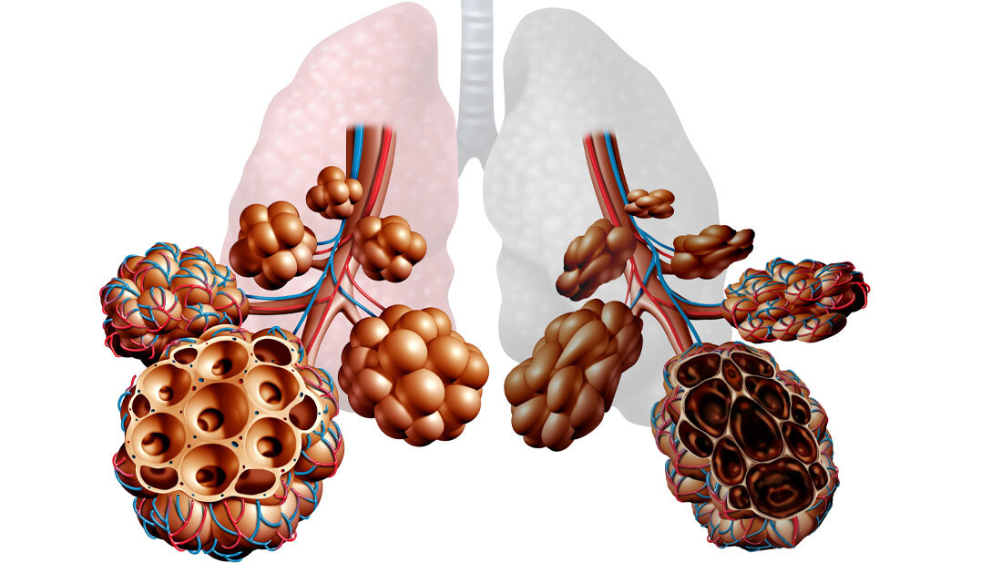 Nutzung von epigenetischem Profiling bei COPD
