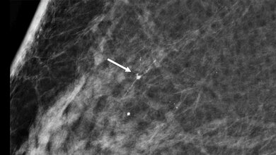 Digitale Screening-Mammographie 