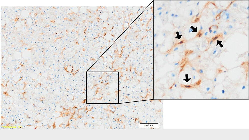 Immunhistochemische_Anfaerbung_des_Botenstoffs_BMP_9_braun_in_einem_Gefrierschnitt_humaner_Leber_UMM.jpg Immunhistochemische Anfärbung des Botenstoffs BMP-9