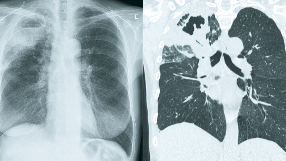 Bildgebung bei Tuberkulose Pneumologie