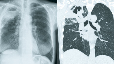 Bildgebung bei Tuberkulose Pneumologie