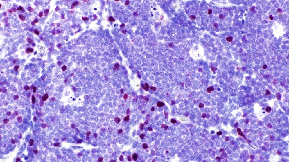 Mantelzelllymphom_Ki67_niedrig_UKSH_04032016.jpg Mantelzelllymphom Ki67 niedrig