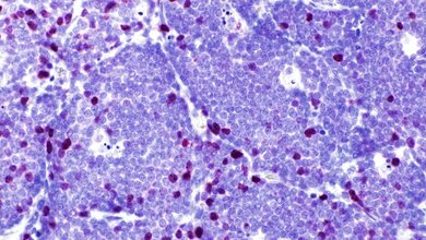 Mantelzelllymphom_Ki67_niedrig_UKSH_04032016.jpg Mantelzelllymphom Ki67 niedrig