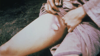 Pestpatientin_zeigt_Symptome_CDC_public_domain.jpg Pestpatientin zeigt Symptome
