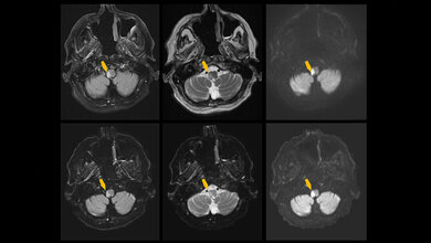 Schlaganfall_MRT.jpg Schlaganfall MRT
