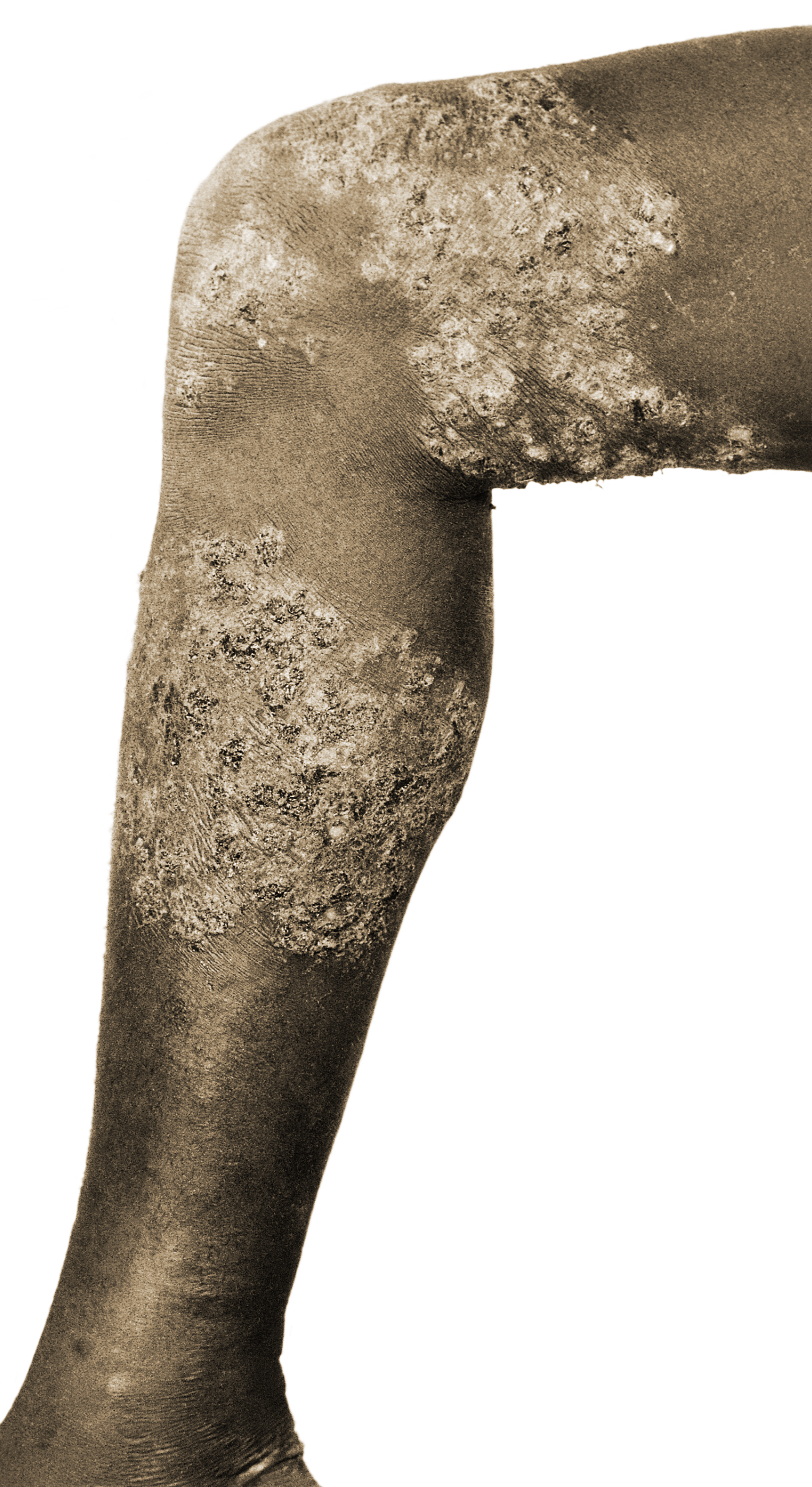 Foto eines Beines mit chronischer Onchozerkose-Infektion.