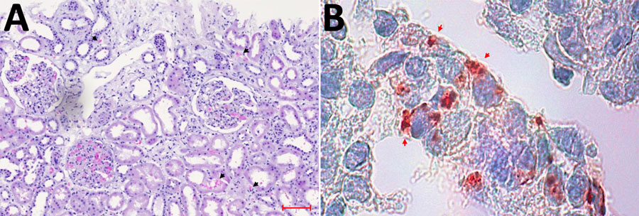 Lichtmikroskopische Analyse und immunhistochemische Färbungsergebnisse der Nierenbiopsie eines Indexpatienten.