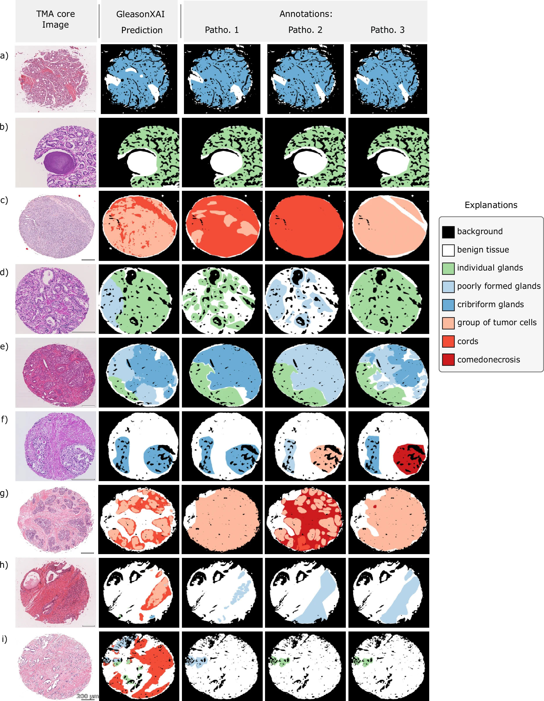 Visualisierung von Beispielen für Segmentierungsergebnisse des GleasonXAI-Modells.