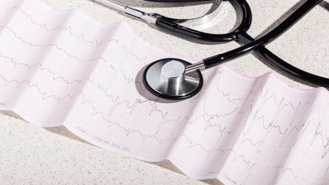 Dieses Bild zeigt ein Stethoskop, das auf einem Elektrokardiogramm (EKG)-Ausdruck liegt, welcher die Herzaktivität darstellt.