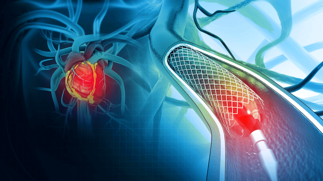 Dieses Bild zeigt eine schematische Darstellung eines medizinischen Eingriffs am Herzen oder an den Blutgefäßen. Links ist ein Herz mit hervorgehobenen Blutgefäßen zu sehen, während rechts ein Stent oder Ballonkatheter dargestellt wird, der in ein Blutgefäß eingeführt wird. 